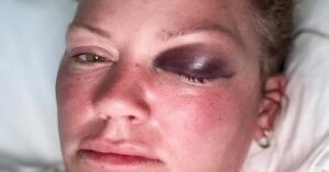 En la foto se observa una turista canadiense con un ojo morado, golpeado