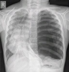 En la foto, una radiografía donde se ve un pulmón con problemas