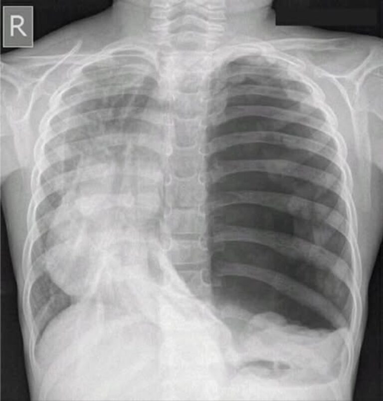 En la foto, una radiografía donde se ve un pulmón con problemas