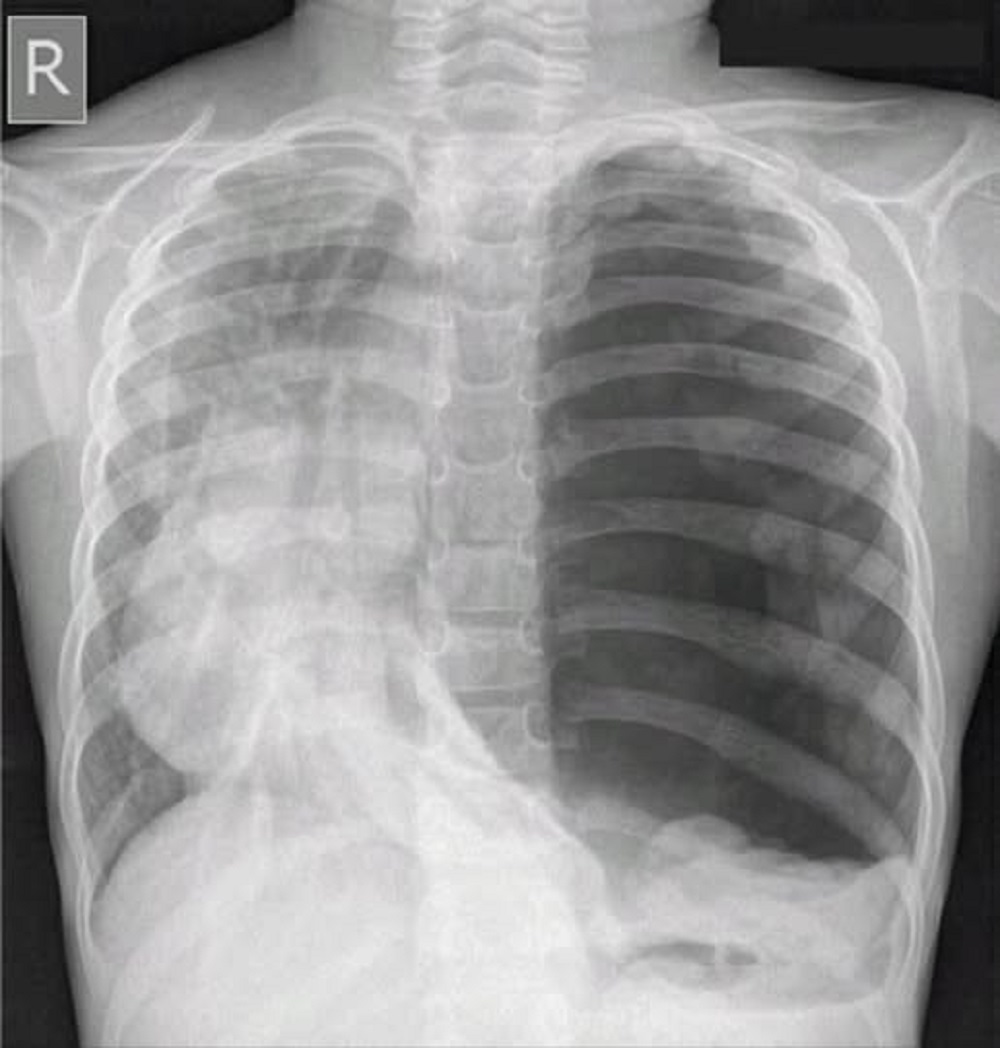 En la foto, una radiografía donde se ve un pulmón con problemas