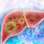 En la foto, hepatitis