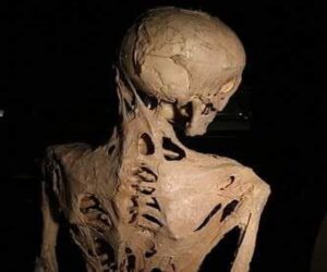 En la foto, esqueleto de una persona con Fibrodisplasia Osificante Progresiva, o FOP