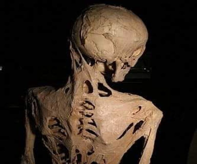 En la foto, esqueleto de una persona con Fibrodisplasia Osificante Progresiva, o FOP