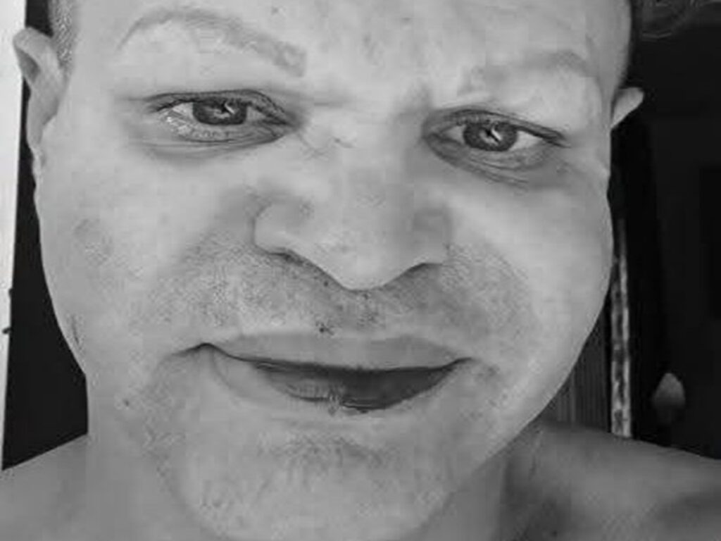 Transformista cubano denuncia agresión tras quejarse de los apagones 2 En la foto, el rostro de Raciel tras ser golpeado