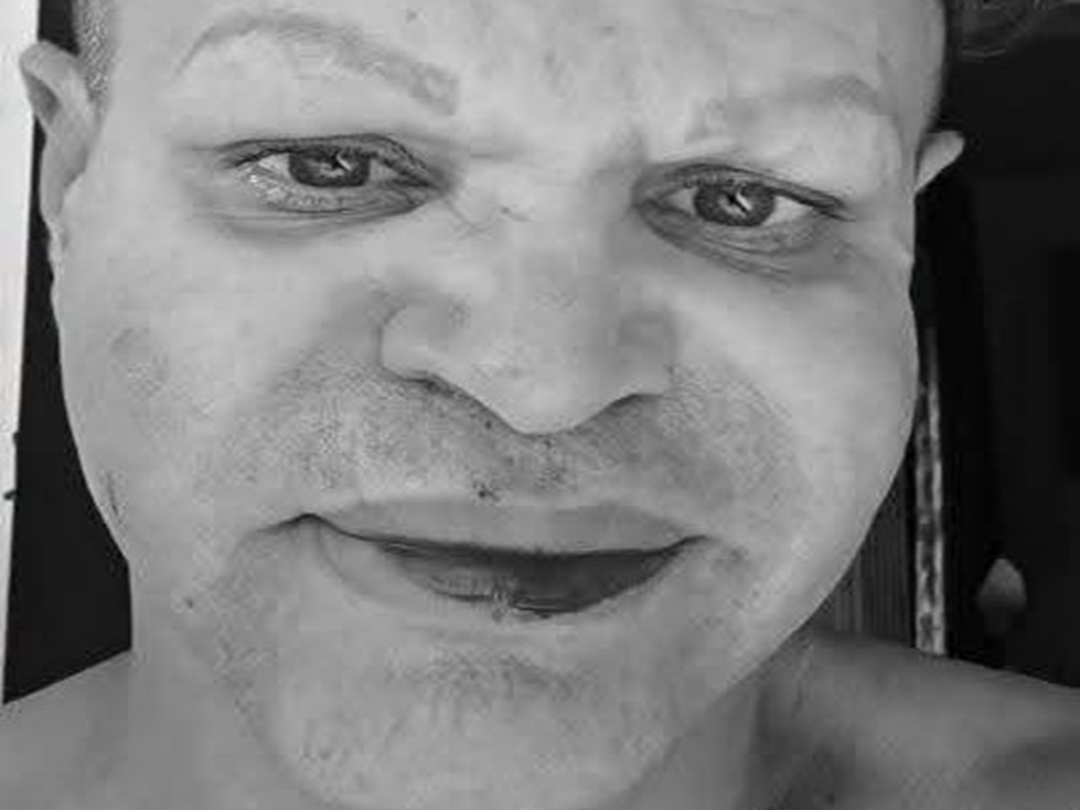 Transformista cubano denuncia agresión tras quejarse de los apagones 1 En la foto, el rostro de Raciel tras ser golpeado