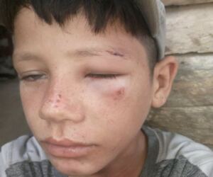 En la foto, el niño agredido por un colaborador de la Policía en Las Tunas