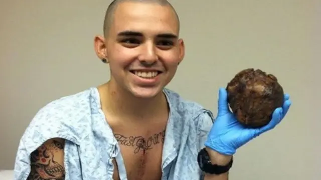 En la foto, Brandon Linkenhoker con su corazón en la mano